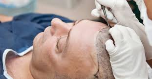 What's the best hairstyle going in for surgery? Do Hair Transplants Work Types Side Effects And Recovery