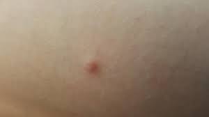 Some people may experience pain with an armpit lump. Hard Lump Under The Skin Causes And Pictures