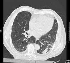 Accumulation of fluid in the chest (pleural effusion), which can . Clinical Consequences Of Asbestos Related Diffuse Pleural Thickening A Review Journal Of Occupational Medicine And Toxicology Full Text