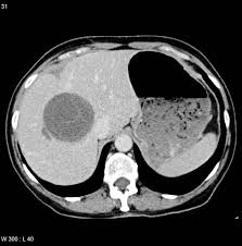 Image result for Liver Abscess