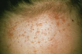 Occasionally, this creates what's known as mosaic warts clusters of small warts that are normally painless (it just keeps getting better and better, doesn't it?). Warts And Verrucas Hse Ie