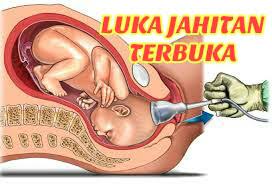 Bagi luka episiotomi, pastikan luka dilapkan sehingga kering selepas ke tandas dan sapu ubat luka yang diberi oleh doktor. Luka Jahitan Bersalin Terbuka Sampai Tak Boleh Berjalan Dan Duduk Wanita Ini Temui Penyelesaiannya Its All About Nature N Passion