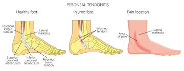 These can easily be torn by violent blows to the face or mouth, thus a torn frenulum is sometimes a warning sign of physical abuse. Peroneal Tendonitis Workup And Nonsurgical Treatment Lower Extremity Review Magazine
