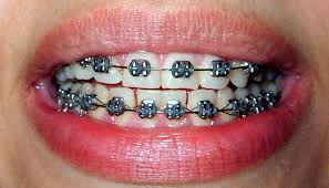 If a bracket dislodges from the tooth but is still on the wire, it can rotate and move along the wire. Broken Braces And Brace Wires Symptoms And Solutions