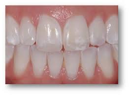 This is often termed as hypocalcification. Brookline White Spot Removal Cosmetic Dentistry Boston Smile Center