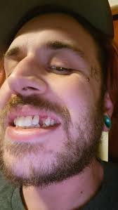 Recently had a tooth come out and now I wanna see what it'd look like if I  had a gold tooth and maybe help fix my teeth to help me work towards