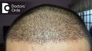 5% of patients do not start growing hair until the 8 th month after the procedure. How Long Does It Take For Hair To Grow After A Hair Transplant Dr Madan Kumar Bj Youtube