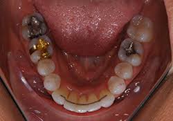 Az dentist is here to help! Bonded Lingual Retainer Komoroski Orthodontics