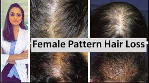 A., bowen j., kealey t. Hair Loss In Women Female Pattern Hair Loss Causes Treatment Dermatologist Youtube