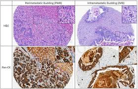 Metastatic colorectal cancer is cancer that has metastasized. Frontiers Evaluation Of Tumor Budding In Primary Colorectal Cancer And Corresponding Liver Metastases Based On H E And Pancytokeratin Staining Medicine