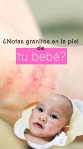 Recuerda que es muy importante consultar con tu Pediatra o Dermatologo para  recibir el tratamiento adecuado y personalizado para tu bebé.