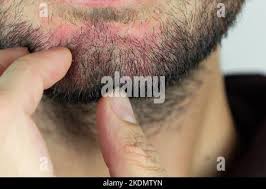 Image result for Beard Dermatitis
