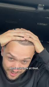 Our hairlines are looking FRESH 😎 thanks to @drmatee at @ksl_clinics we  couldn’t recommend them more 👏