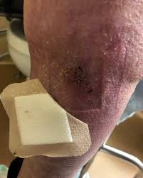 Image result for Skin Tear