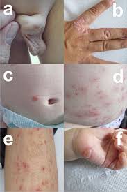 Image result for scabies human children