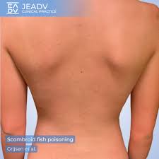 Image result for Scombroid Fish Poisoning