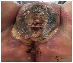 About one per 62,500 males are affected per year. Fournier S Necrosis Associated With Extraintestinal Amebiasis A Rare Presentation Of A Common Infection Journal Of Obstetrics And Gynaecology Canada