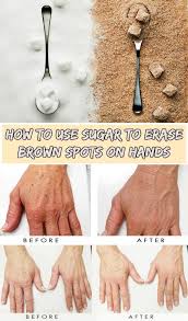 How To Use Sugar To Erase Brown Spots On Hands Welovebeauty Org Brown Spots On Hands Beauty Hacks Brown Spots