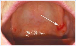 Image result for Erythroplakia roof of mouth