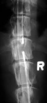 It can occur in a variety of anatomic locations, with the most common being the gastrointestinal tract, nasal cavity, mediastinum (area in the chest between the heart and lungs), and kidneys. Neoplasia Of The Spinal Column And Cord Nervous System Merck Veterinary Manual