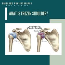 Image result for Frozen Shoulder