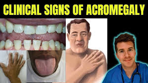 Image result for Acromegaly
