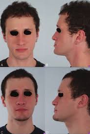 Assessing Patient-Reported Outcomes Following Orthognathic Surgery and  Osseous Genioplasty