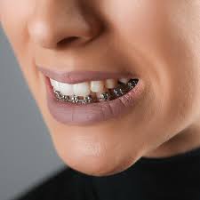How long will it take to close the gap between my two front teeth with braces? Can Your Teeth Shift Back After Braces Align Ortho