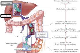 According to the american cancer society, about 135,430 people were diagnosed with colon cancer in 2014.that. Natural History Of Hepatic Metastases From Colorectal Cancer Pathobiological Pathways With Clinical Significance