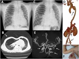 Artery tortuosity syndrome exhibiting early‐onset emphysema with novel  compound heterozygous SLC2A10 mutations