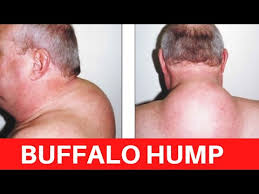 They may lead to a puffy, rounded face and the characteristic hump of fatty tissue at the base of the neck. Buffalo Hump How To Discuss