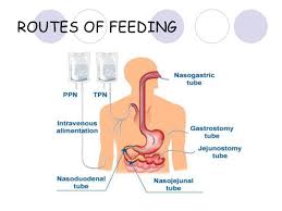 Enteral Feeding Google Search Nursing Notes Nursing Mnemonics Speech And Language