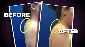 This hump on back of neck is the result of poor posture, slumping, and weak back and core muscles. New Procedure That Gets Rid Of The Buffalo Hump Abc13 Houston