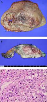 phyllodes breast tumors (pt) range from benign lesions to malignant ones that may give distant metastasis. Benign Phyllodes Tumor Of The Breast Recurring As A Rapidly Growing Recurrent Malignant Phyllodes Tumor A Case Report Iranian Journal Of Radiology Full Text