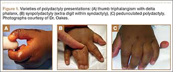 Image result for Polydactyly