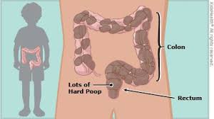 Zapor U Rebyonka Prichiny Simptomy I Lechenie V State Gastroenterologa Danilejchenko N A