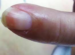 Image result for Muehrcke Line