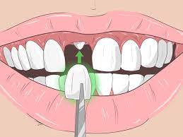 There are no risks or side effects, as long as. 3 Ways To Remove Brown Stains From Teeth Wikihow
