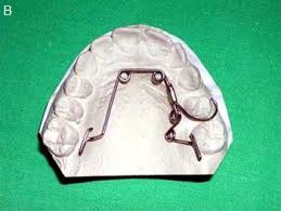Bu ekipman parçaları bedenin ve zihnin terapi ve rehabilitasyon sürecine yardımcı olur. Aparaty Ortodontyczne Jaki Aparat Wybrac Dla Dziecka Pediatria Medycyna Praktyczna Dla Pacjentow