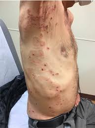 Image result for Pemphigoid