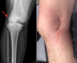 Pucker Sign In Irreducible Posterolateral Knee Dislocation