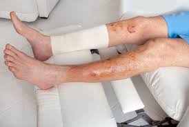 Image result for Wound