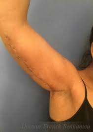 La chirurgie réparatrice est ce pourquoi la chirurgie plastique fut créée. La Brachioplastie Le Lifting Des Bras