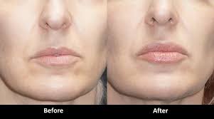 See before and after juvederm pictures from the cosmetic skin clinic. Filler Before And After Pictures Med Spa In Encino Ca A E Skin Professional
