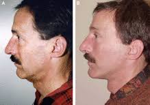Male Facelift