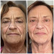 Basic moisturizer for dry and crepey skin