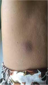 15 hours ago · cdc investigates fatal case of rare tropical disease melioidosis. Melioidosis Wikipedia