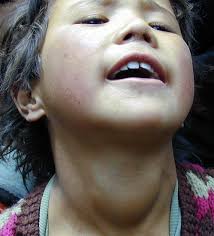 Research of endemic goiter has been linked to goiter, hypothyroidism, hyperthyroidism, thyroid researched pathways related to endemic goiter include excretion, pathogenesis, secretion. The Iodine Deficiency Disorders Endotext Ncbi Bookshelf