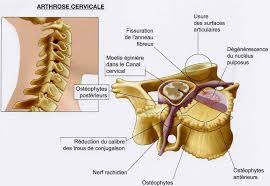Il le diagnostic et le traitement des douleurs cervicales. Cervicalgie Nevralgie Cervicale 6 Questions Frequentes Lors D Un Mal De Cou Clinique Chiropratique Sillery Chiro A Ste Foy Quebecclinique Chiropratique Sillery Chiro A Ste Foy Quebec