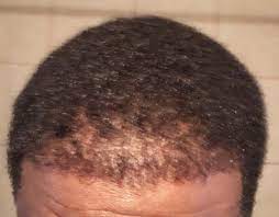 Patients would usually invest with this amount in mind. Botched Bosley Hair Transplant Review Realself